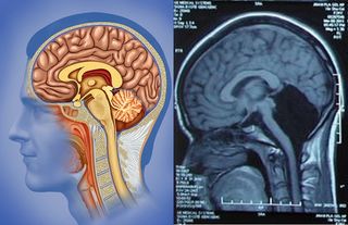 Brain scans revealed the patient's brain was missing the cerebellum, which normally resides on the back of the head.