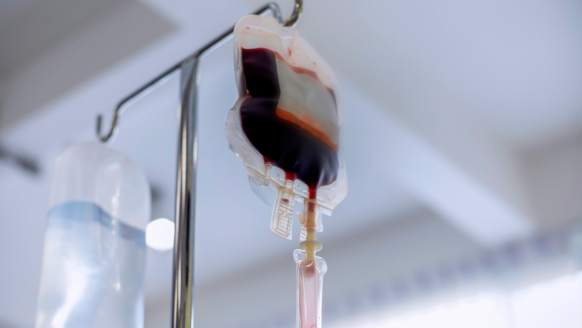 A close up of a hanging blood bag full of blood with a plastic tube underneath.