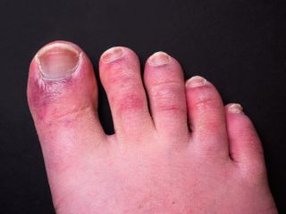 Covid toes, characterised by red and itchy rashes on the toes.