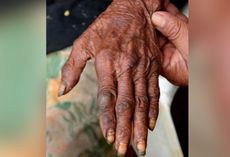 Sand fleas are parasites that burrow into people's skin, causing intense pain, itching and inflammation. A new report describes five cases of "extreme" sand flea infections. Above, an image showing embedded sand fleas on the back of a patient's hand.