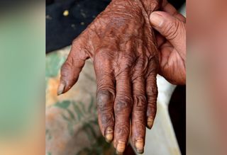 Sand fleas are parasites that burrow into people&#039;s skin, causing intense pain, itching and inflammation. A new report describes five cases of &quot;extreme&quot; sand flea infections. Above, an image showing embedded sand fleas on the back of a patient&#039;s hand.