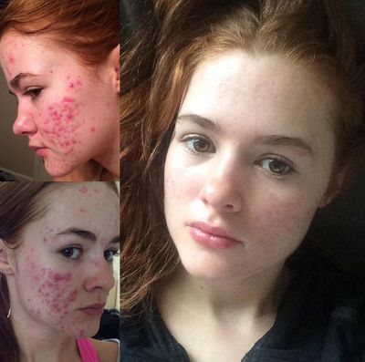 The Best Accutane Before-and-After Results - Kali Kushner of ...