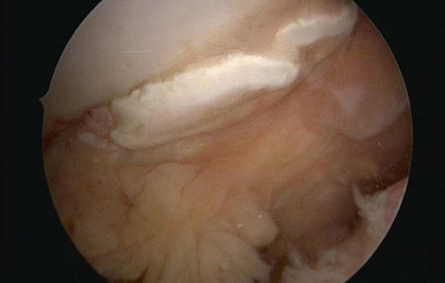 : fragments can be the result of trauma, such as a direct impact from hitting a fence. The arthroscopic image, top, and X-ray below, show a stifle with fragmentation from the patella. There are further fragments visible on the X-ray free-floating in the joint from the femoral ridges