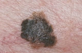 A photo of intermediate melanoma.