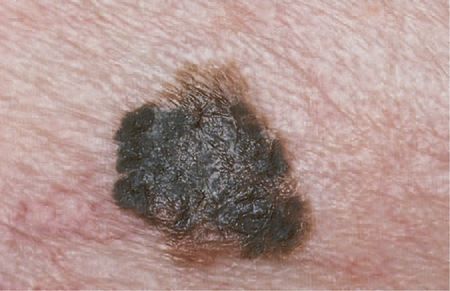 Melanoma tumor