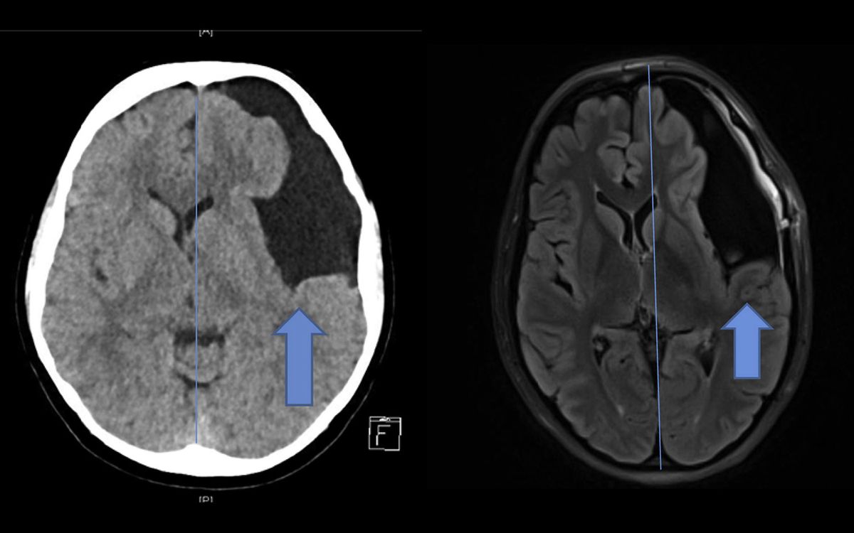 The woman&#039;s symptoms began right after she had &quot;cervical spine manipulation,&quot; a common chiropractic procedure to treat neck and back pain. Brain imaging revealed she had a large cyst that had likely been there fore decades. Above, images of the brain cyst