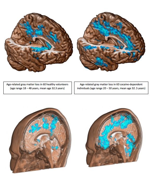 Brain loss caused by cocaine addiction.