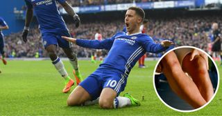 Eden Hazard doing a knee slide with an inset image of the burn marks on his knees