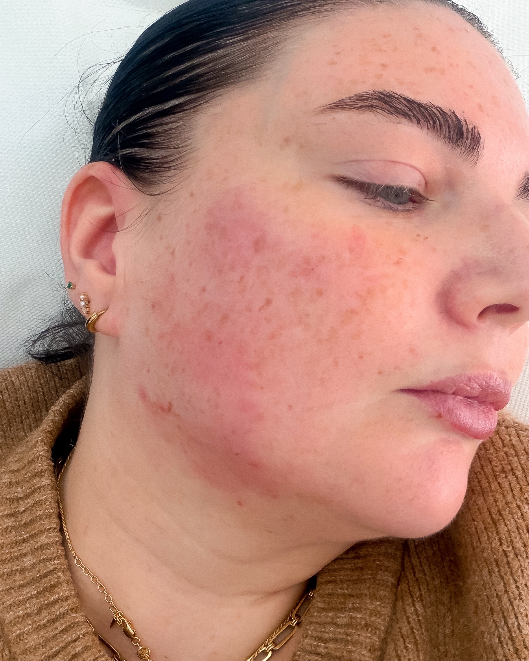 SKINVIVE&amp;trade; and HArmonyCa&amp;trade; immediately after image
