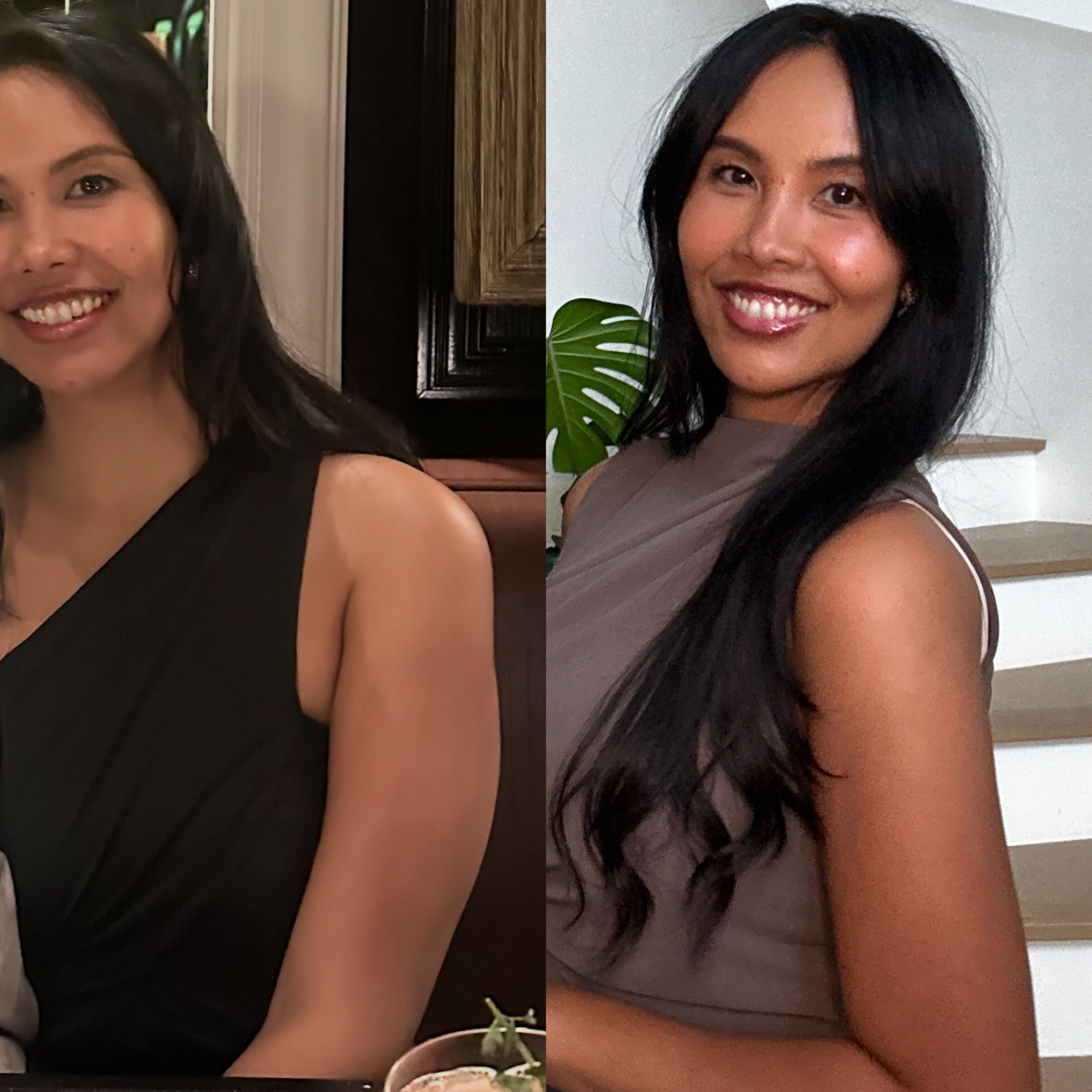 Vanessa Lee's before and after photos after Onda Pro treatments
