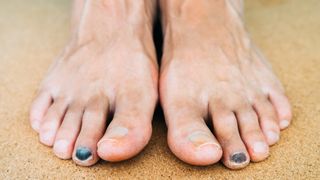 Black toenails in runners are often caused by repetitive trauma
