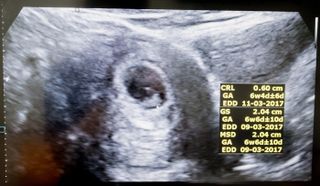 An ultrasound of an embryo at 6 weeks.