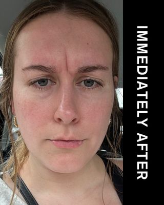 beauty editor Kaitlyn McLintock immediately after Botox