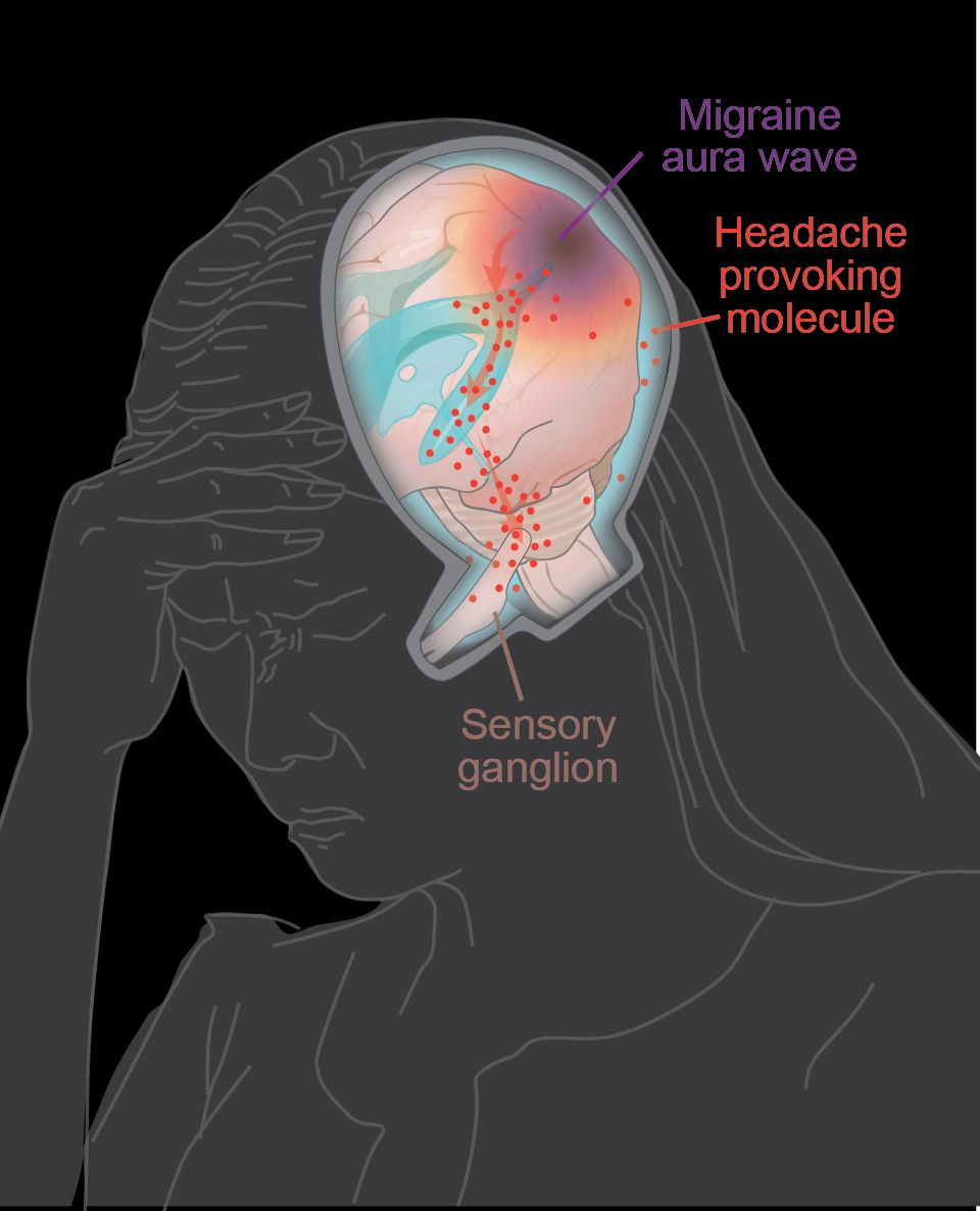 Innovative Research Sheds Light On Migraine Mechanisms And Potential 