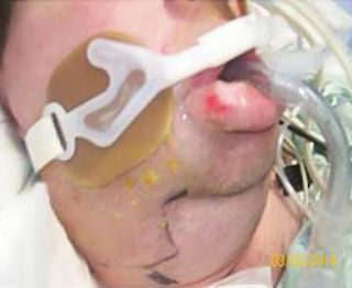 The man's face and neck became significantly swollen after he huffed three cans of air duster.