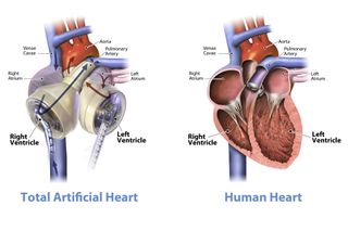 A comparison between a human heart and the SynCardia Total Artificial Heart.
