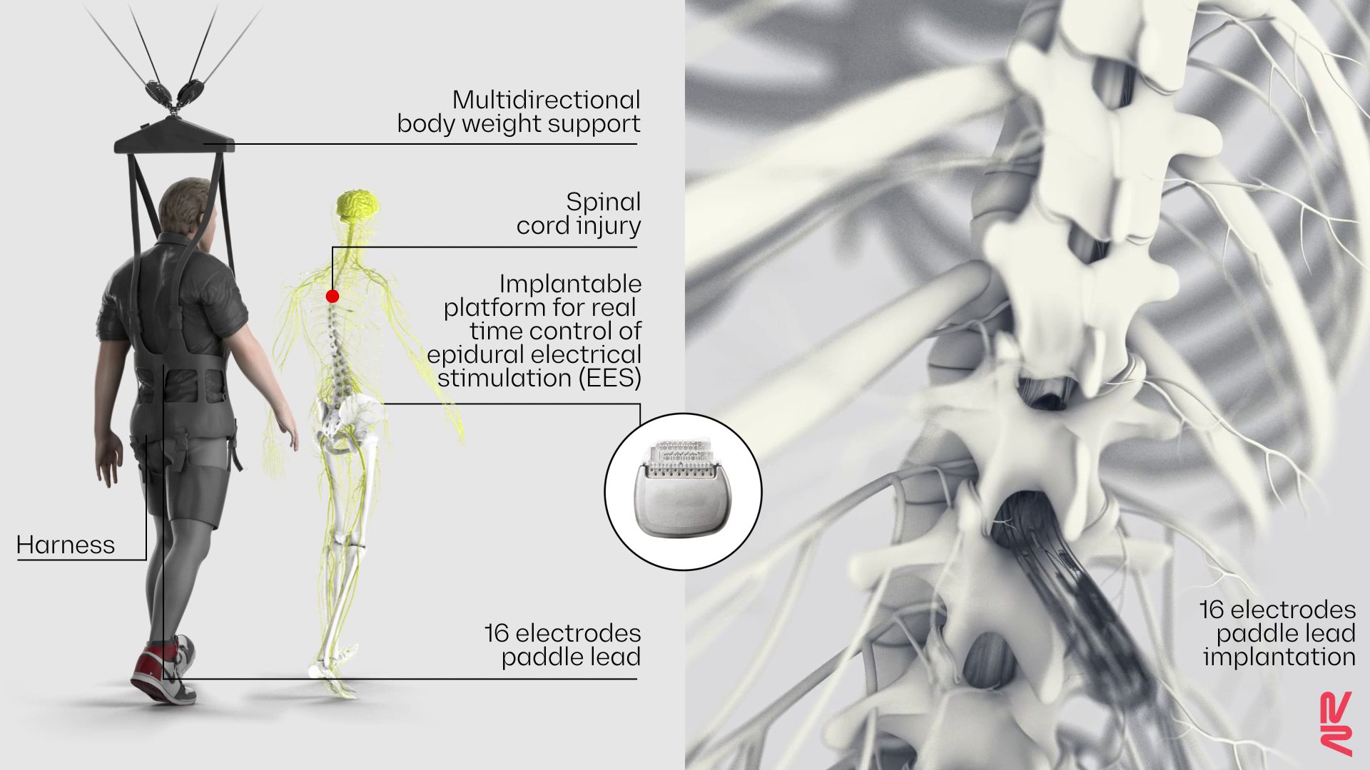 diagram shows a person in a weight-bearing harness next to an illustration of their nervous system, with an electrode-loaded device implanted on the lower spinal cord