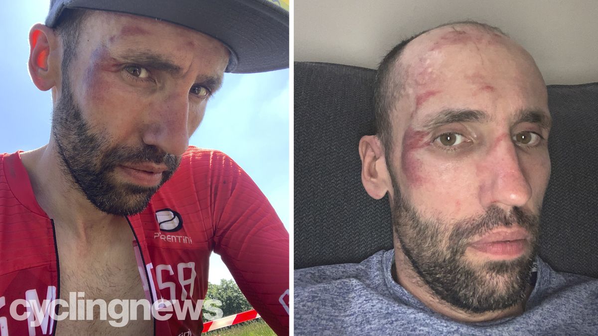 Bruised face of author Aaron Borrill