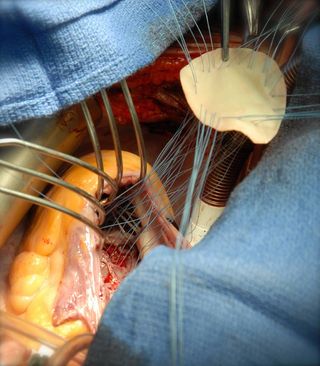 surgery to repair a hole in the heart.