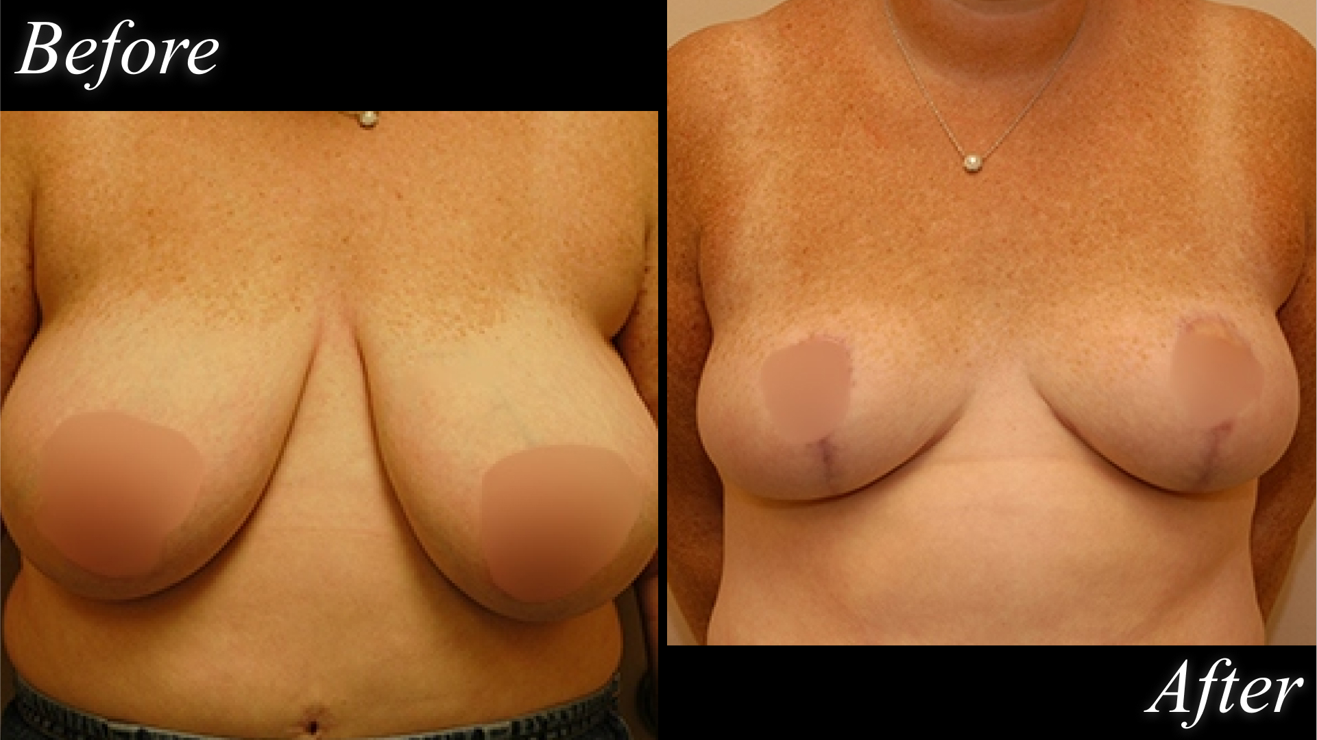 breast reduction before and after picture