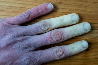 frostbitten hand
