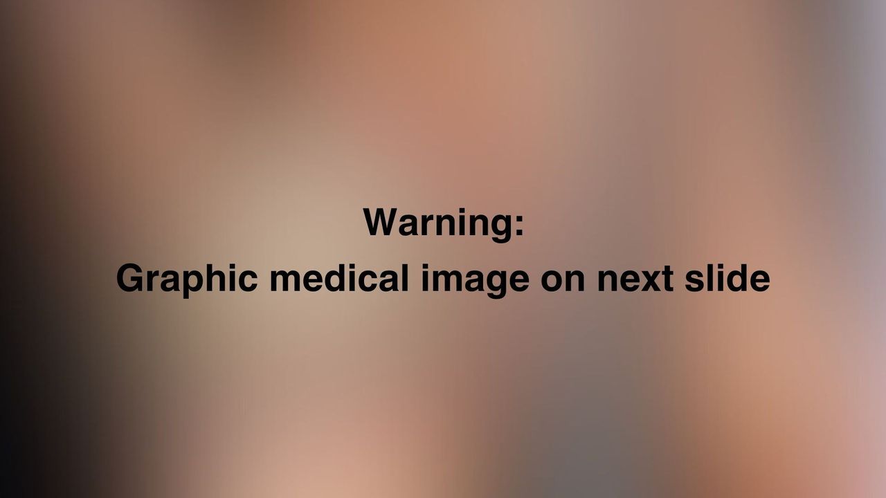 Image with a blurred background and bold black text on top. The text reads "Warning: graphic medical image on next slide"