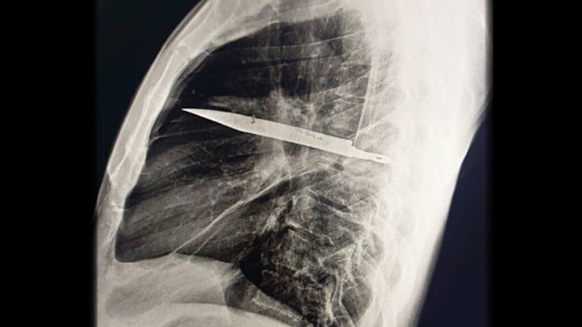 an x-ray image of a knife lodged in a man&#039;s chest