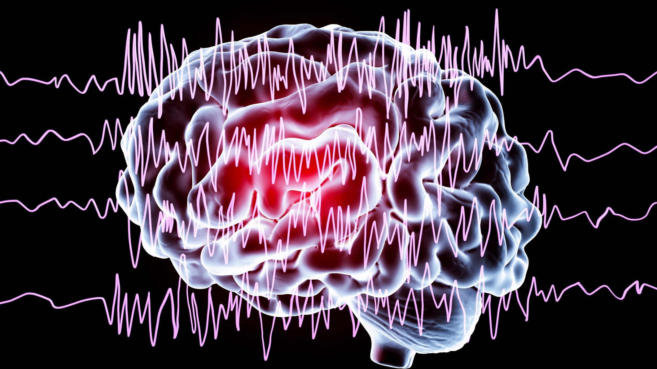 High-tech epilepsy warning device could save lives