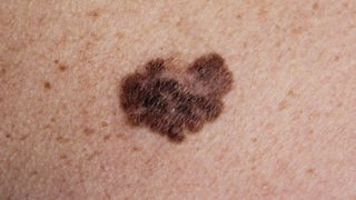 Close up of melanoma mole on the pale skin. It is a roughly heart-shaped dark brown mole with jagged edges.