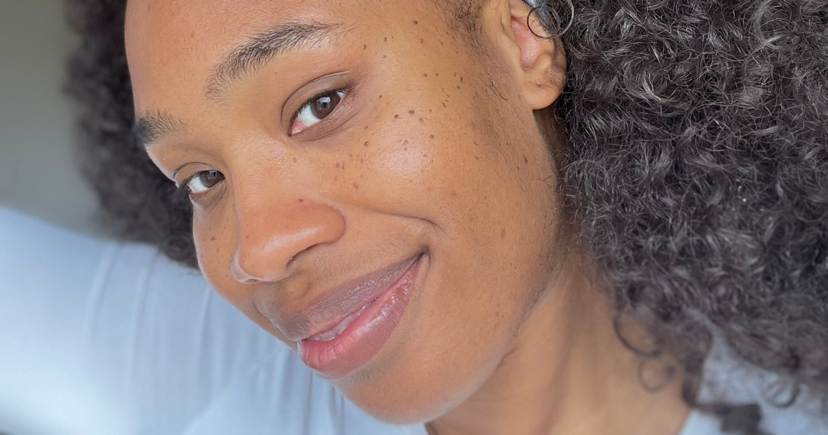 L'Or&eacute;al Blackett dermatosis papulosa nigra