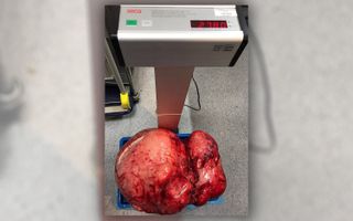 Doctors weighed the fibroid after it was surgically removed.
