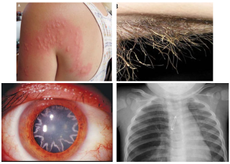 A collection of images from odd case reports: a woman's allergic reaction to a caterpillar, an infection on a man&rsquo;s armpit hair, a man with a star-shaped cataract, and lightbulb lodged in an infant&rsquo;s lungs.