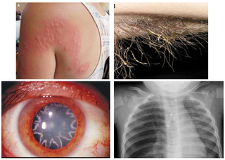 A collection of images from odd case reports: a woman's allergic reaction to a caterpillar, an infection on a man’s armpit hair, a man with a star-shaped cataract, and lightbulb lodged in an infant’s lungs.