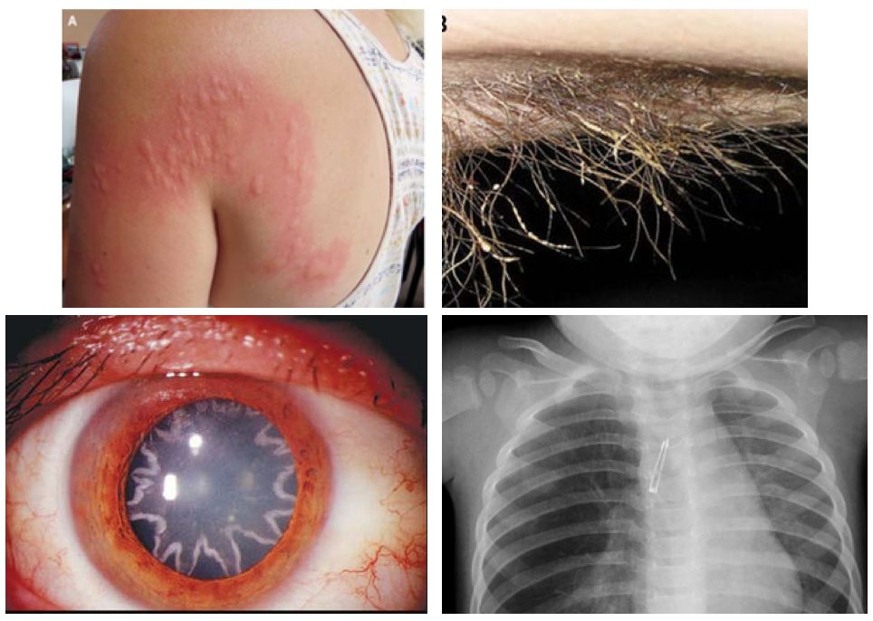 A collection of images from odd case reports: a woman&#039;s allergic reaction to a caterpillar, an infection on a man’s armpit hair, a man with a star-shaped cataract, and lightbulb lodged in an infant’s lungs.