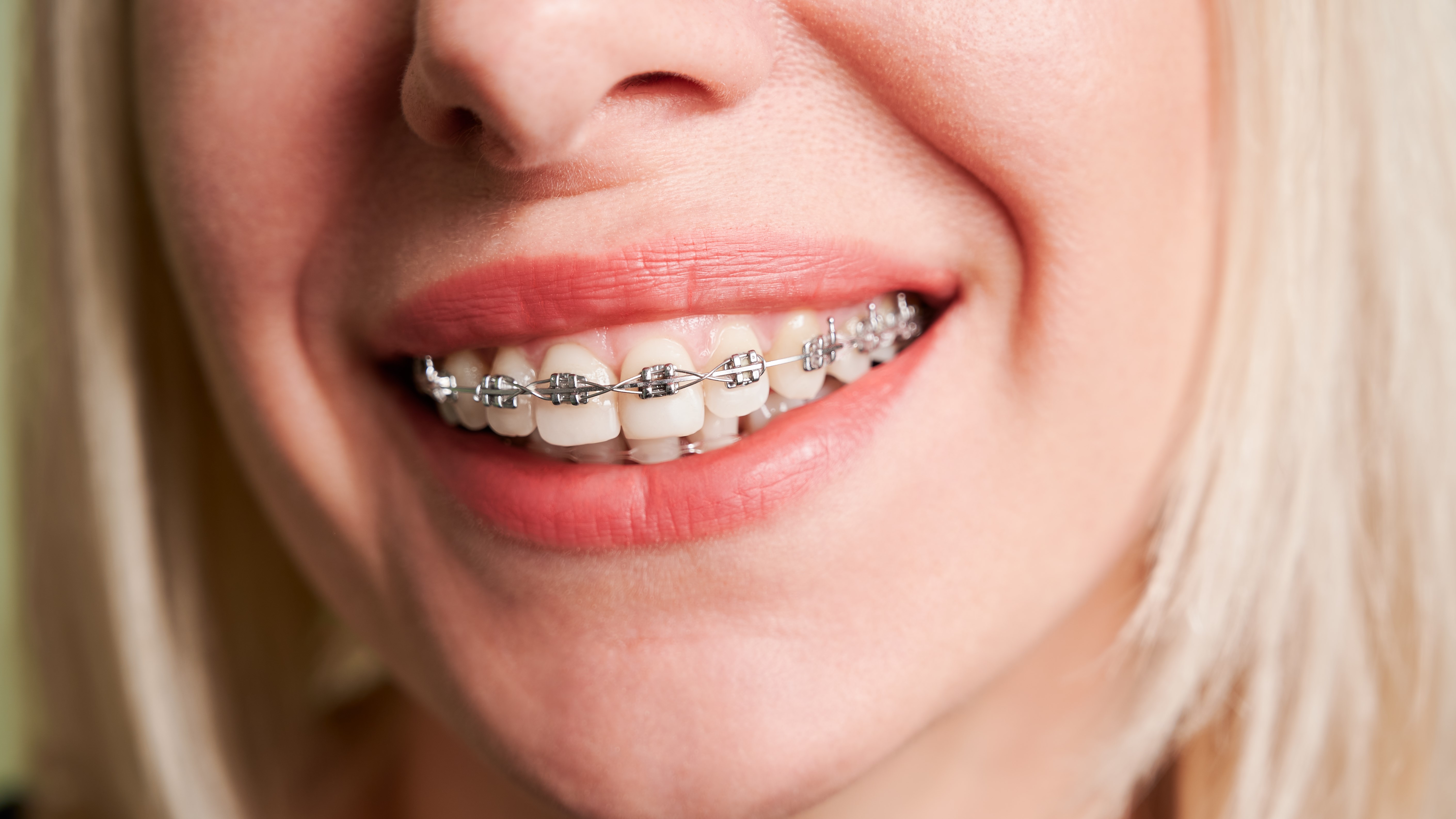 The four types of braces explained by dental experts dental News