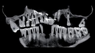 X-ray photographs of the skeleton's jaws and teeth show where the fine gold wires were placed to tighten the woman's teeth in place.