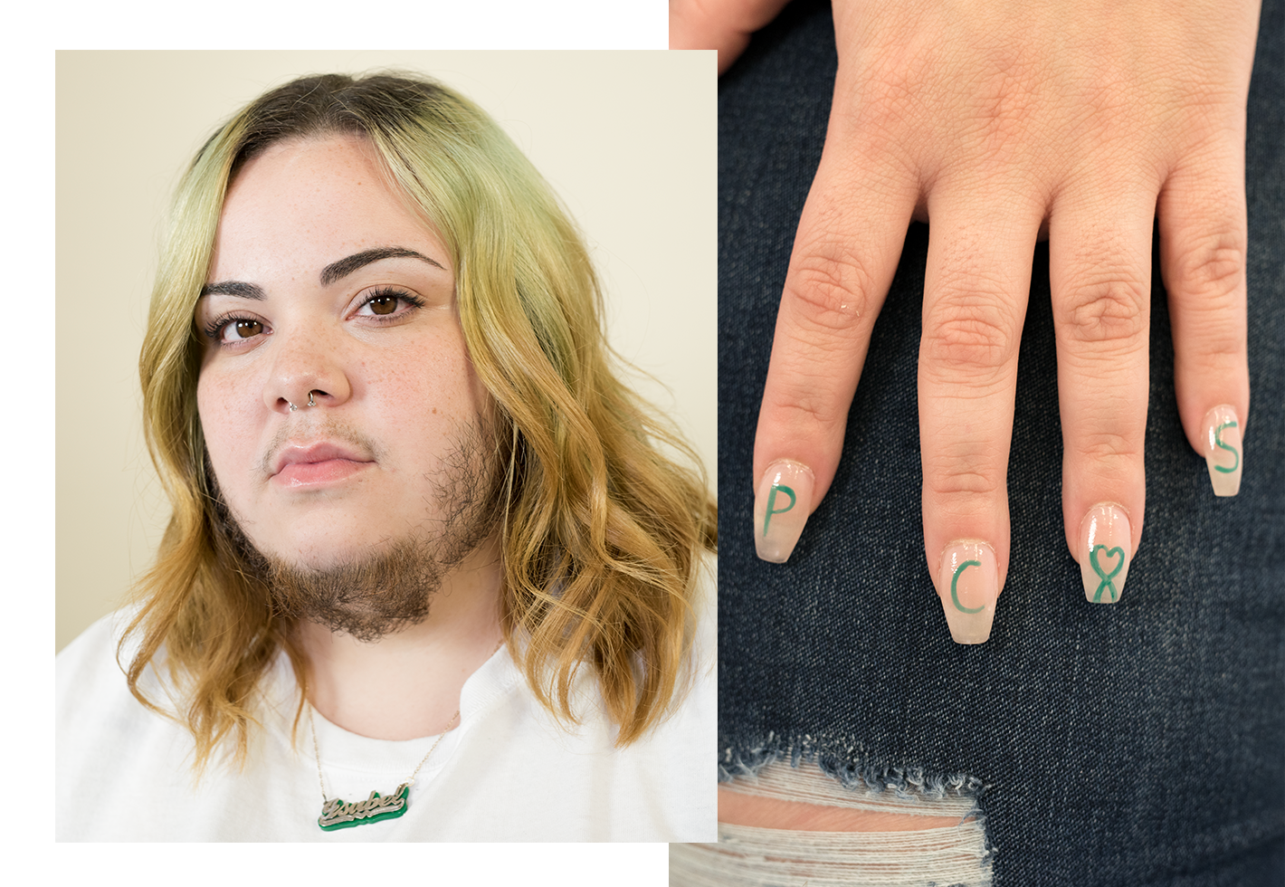 Female Hirsutism Stories Facial Hair on Women Who Wear Mustaches