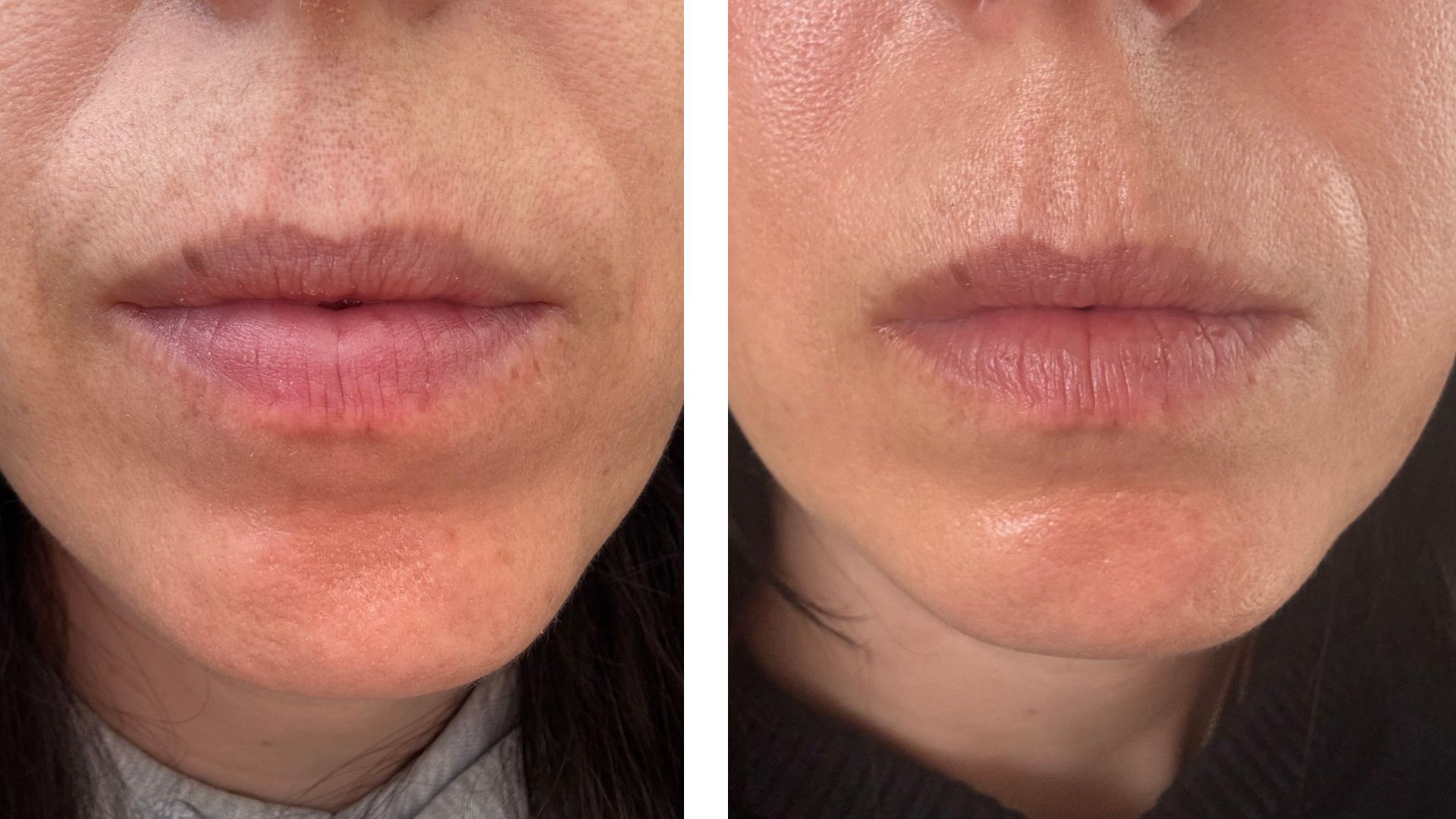 Before and after images of beauty editor Stephanie Maylor using the Tria 4X Hair Removal Laser