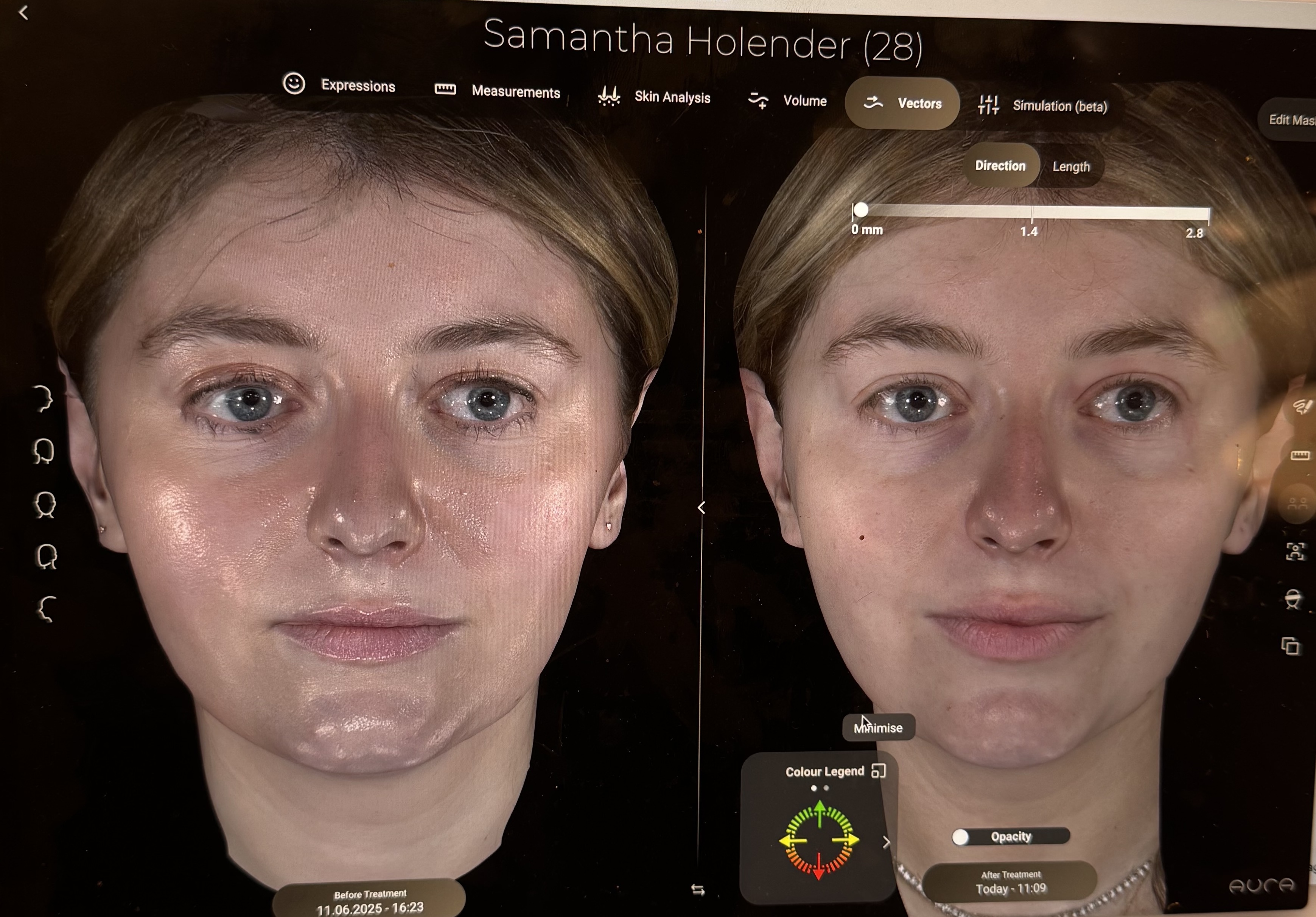 samantha holender before and after sofwave treatment