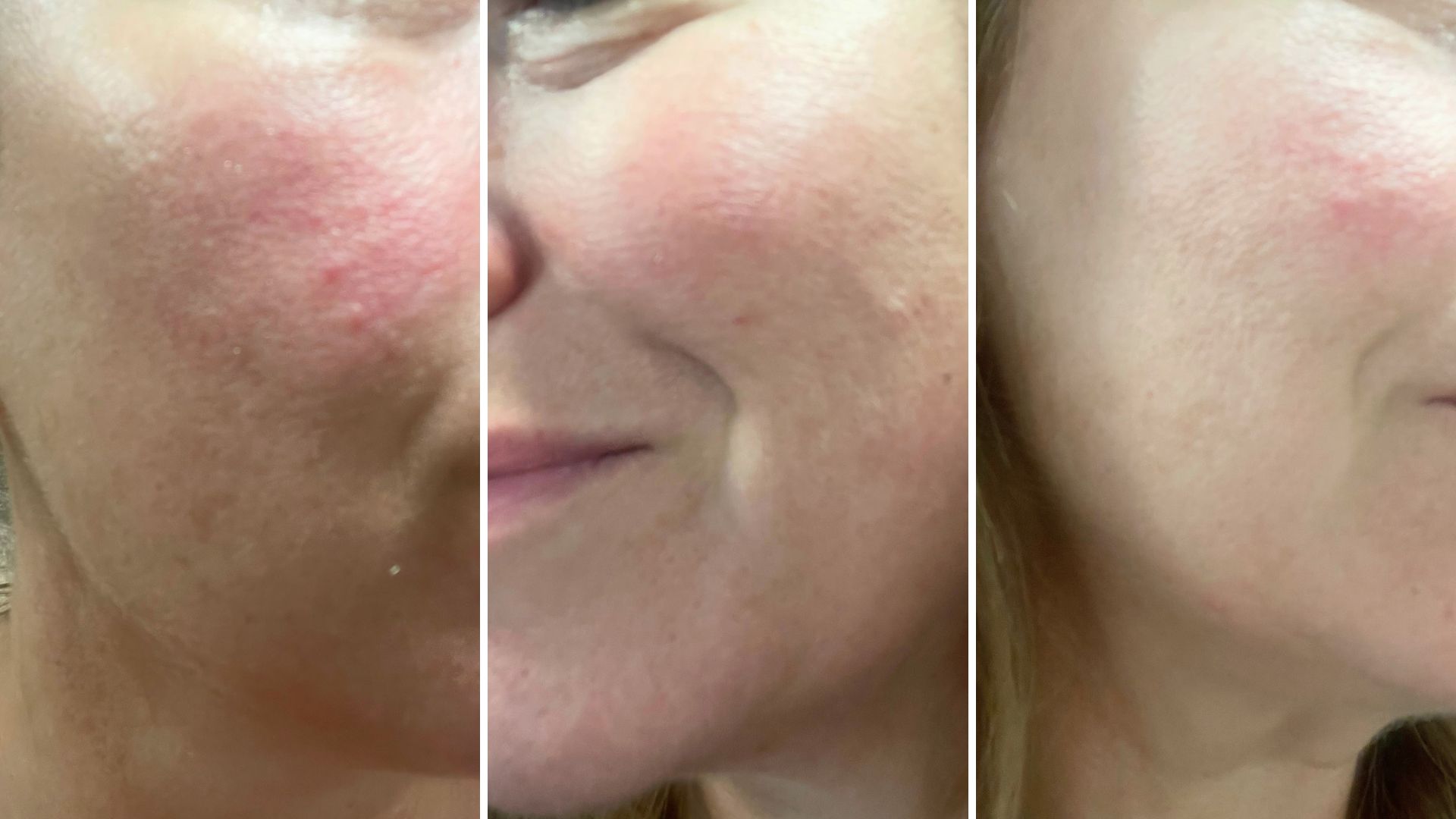 Three close-up images of tester Rachael Samuelson's face, demonstrating the effectiveness of Dr Althea 345 Relief Cream on her rosacea after just two weeks of use.