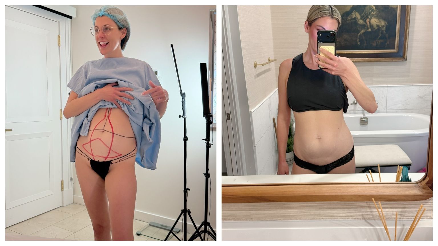I Lost 60 Pounds on a GLP-1—So I Got a Tummy Tuck and Skinny BBL