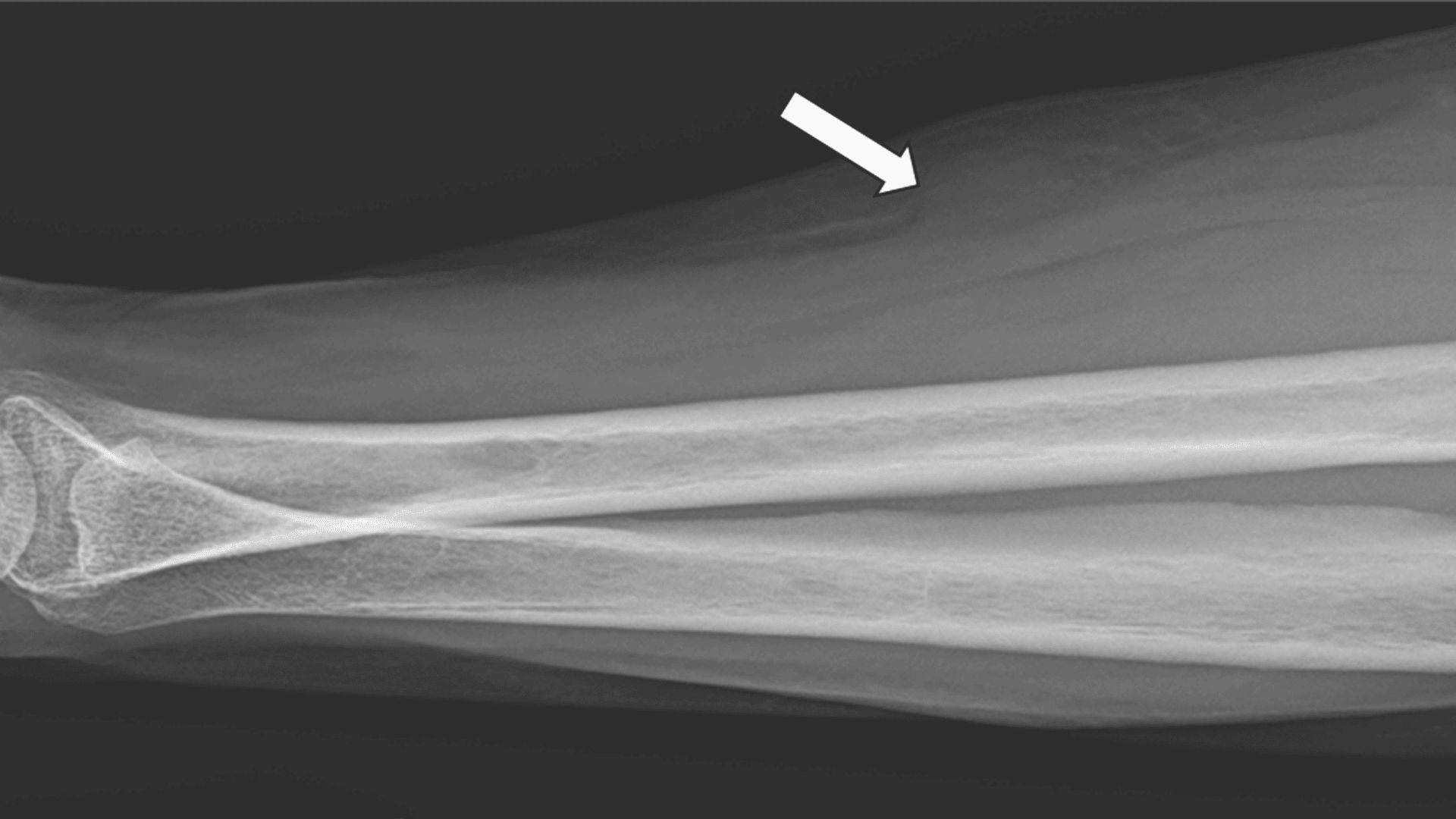 X ray of an arm marked with a small arrow, showing where a small lump is within the tissue