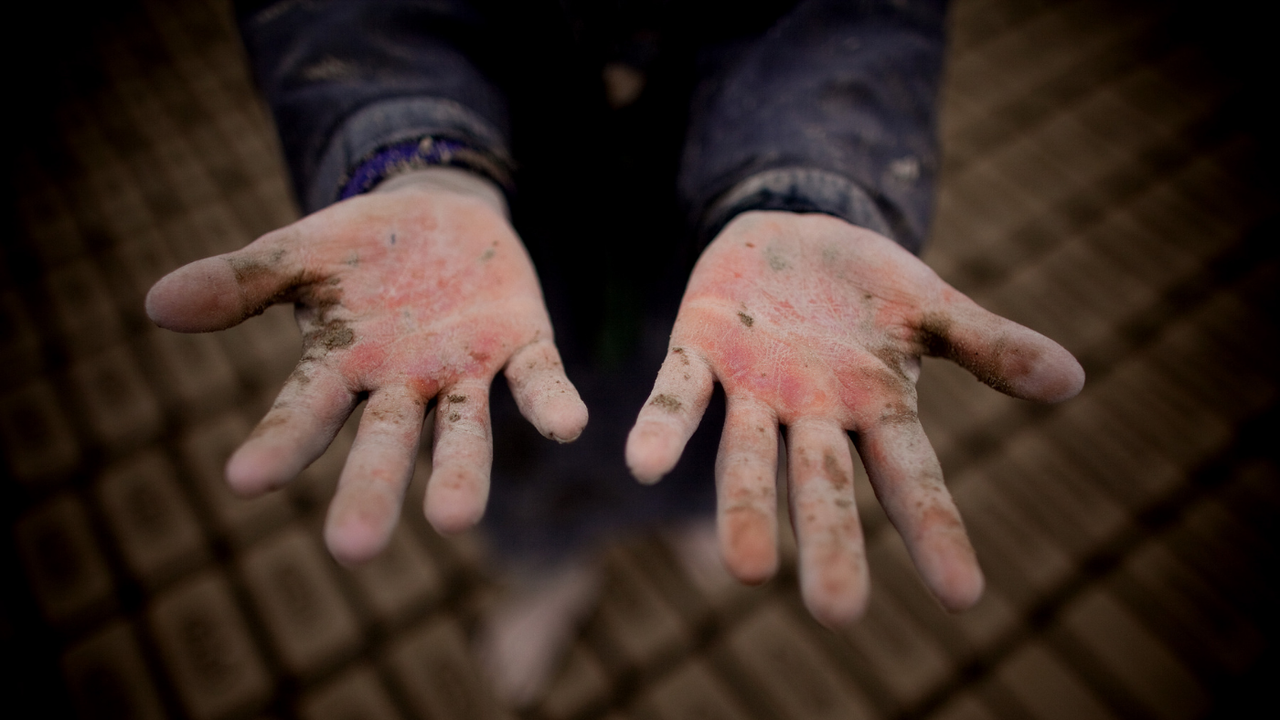 Child holds out blistered and red hands