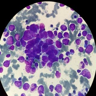 Neuroblastoma cells in the bone marrow.
