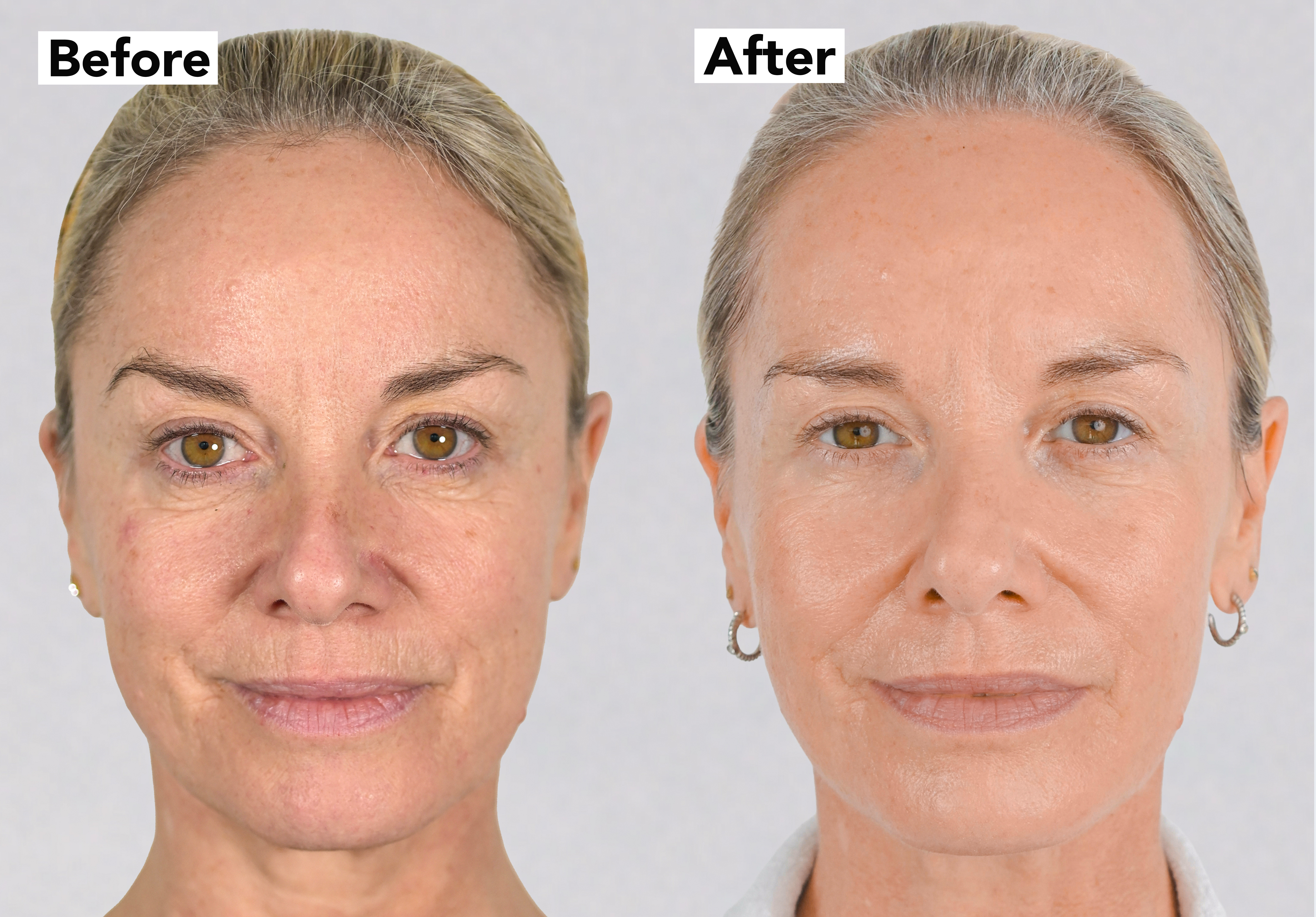 Tamzin Outhwaite before &amp;amp; after NeoGen plasma
