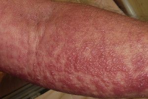 A spider bite led to a nearly full body rash in a man in southern France.