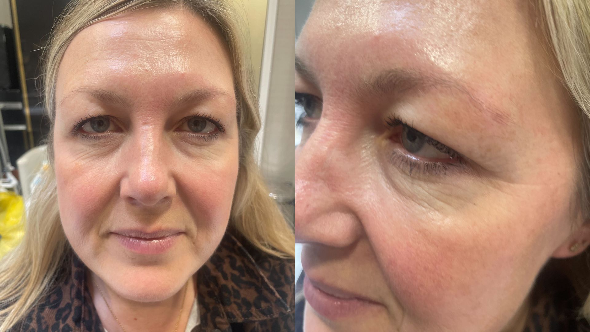 Satah Cooper white pictured before and during microblading