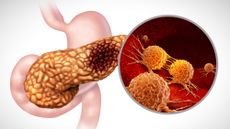 Illustration of pancreas with metastatic cancer