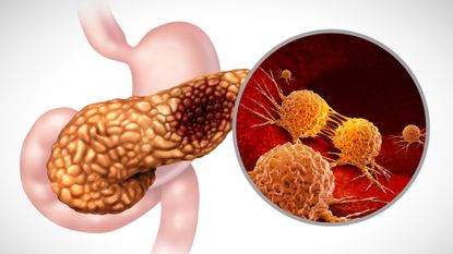 Illustration of pancreas with metastatic cancer
