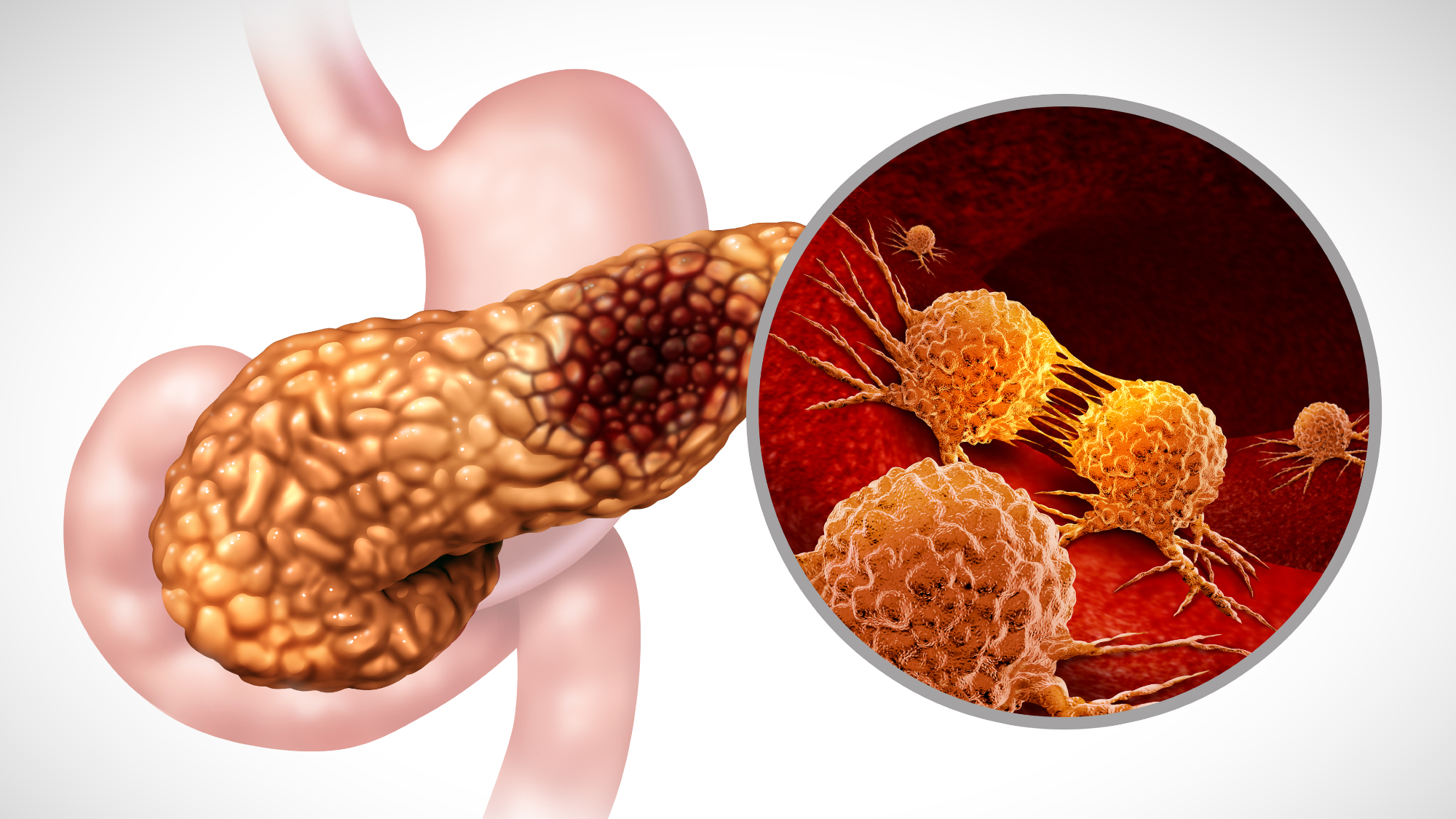 Illustration of pancreas with metastatic cancer